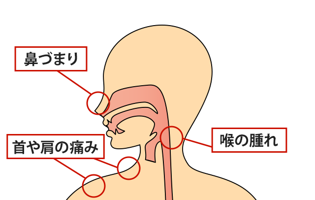 症状の該当箇所のイラスト